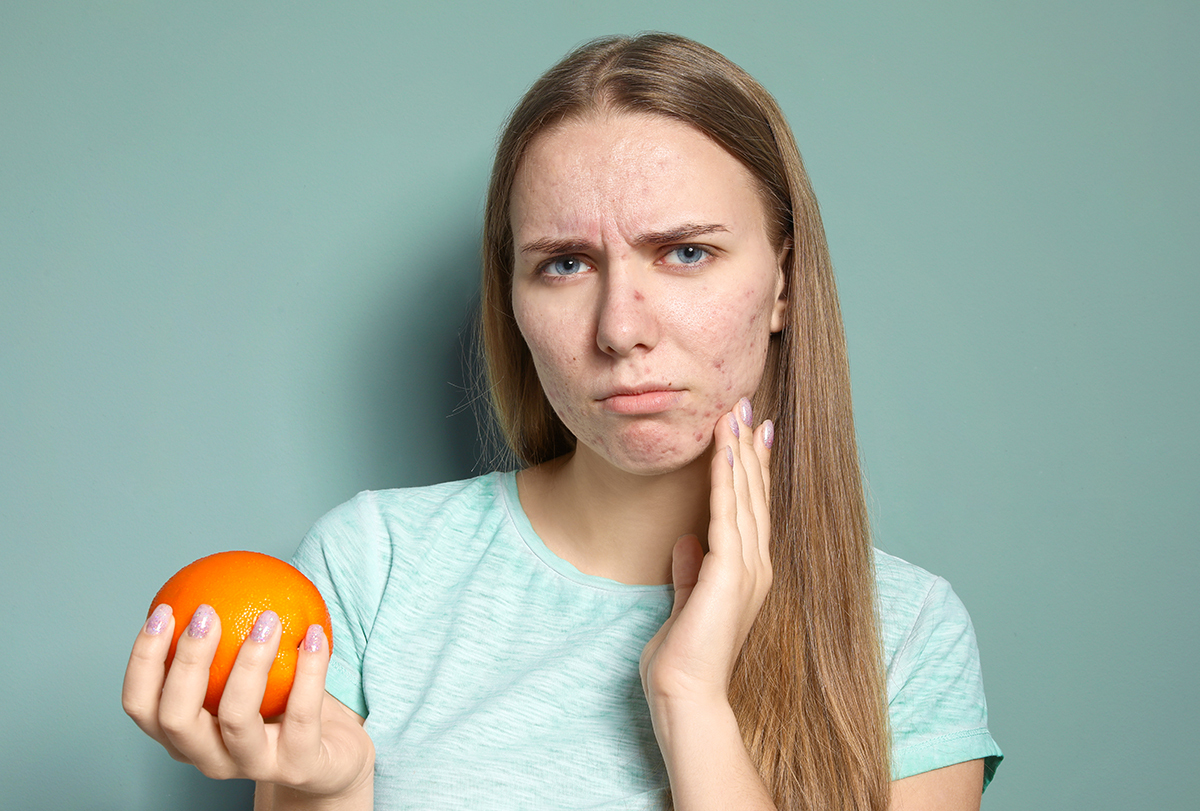 is eating oranges good for acne prevention?